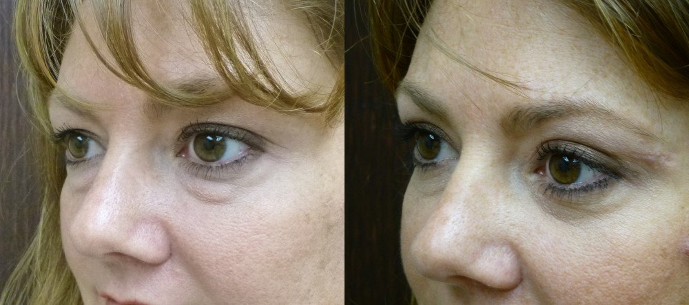 Before and after Upper and lower Eyelid Lift Surgery 