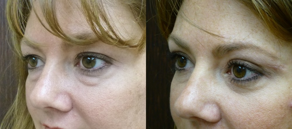 Eyelid Lift Savannah