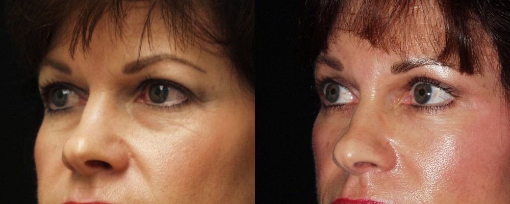 Eyelid surgery - Before and after Upper and Lower Eyelid Lift 
