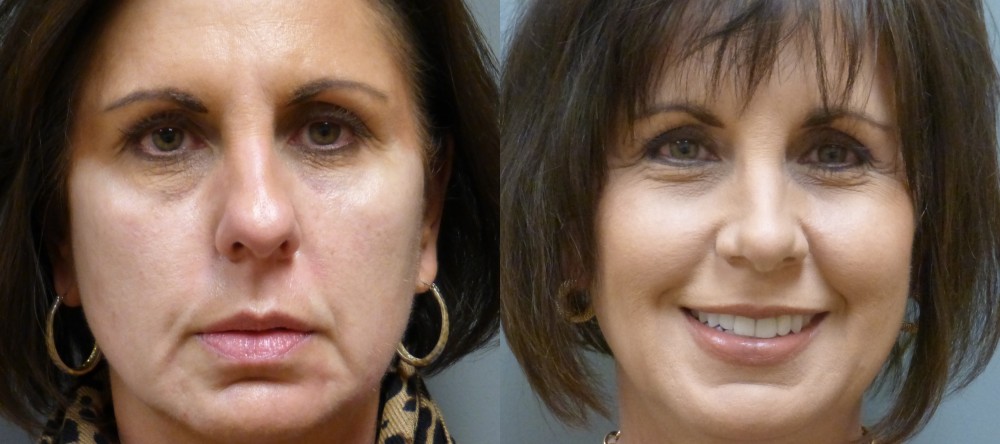Savannah Nose Job Rhinoplasty