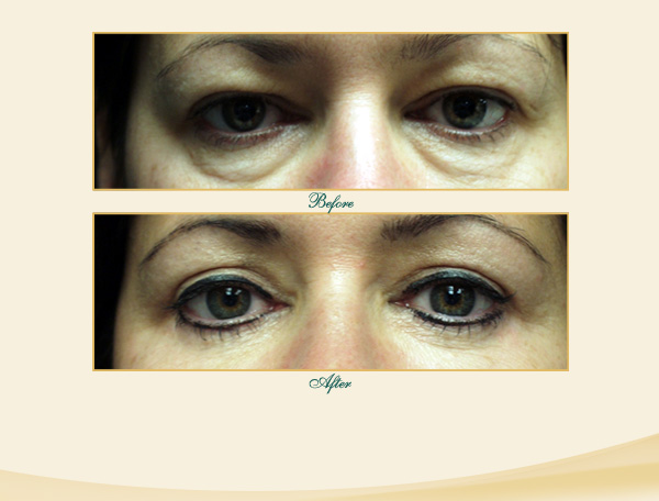 Brow & Eyelid lift