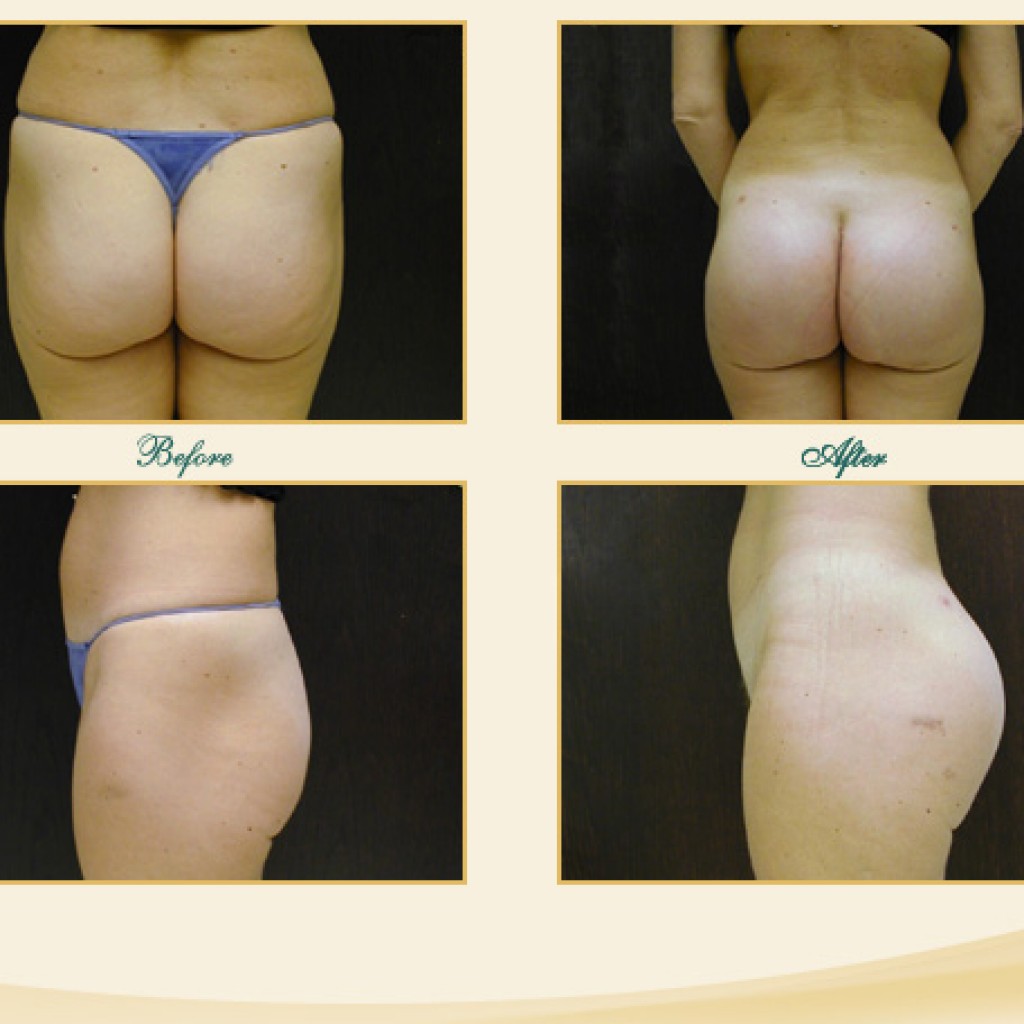 Tustin sculptra butt lift because nothing gets left behind