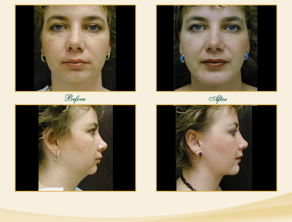 Chin augmentation savannah submental liposuction.