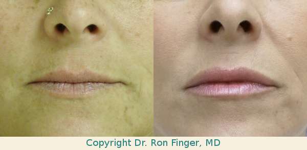 Juvederm savannah lip injections