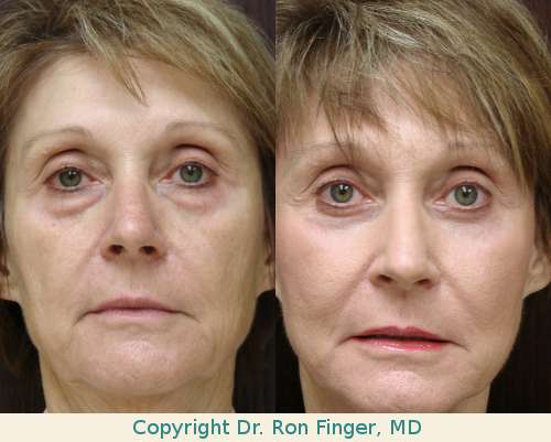 lower lid blepharoplasty savannah fraxel laser