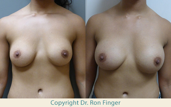 Breast Lift Gallery E. Ronald Finger