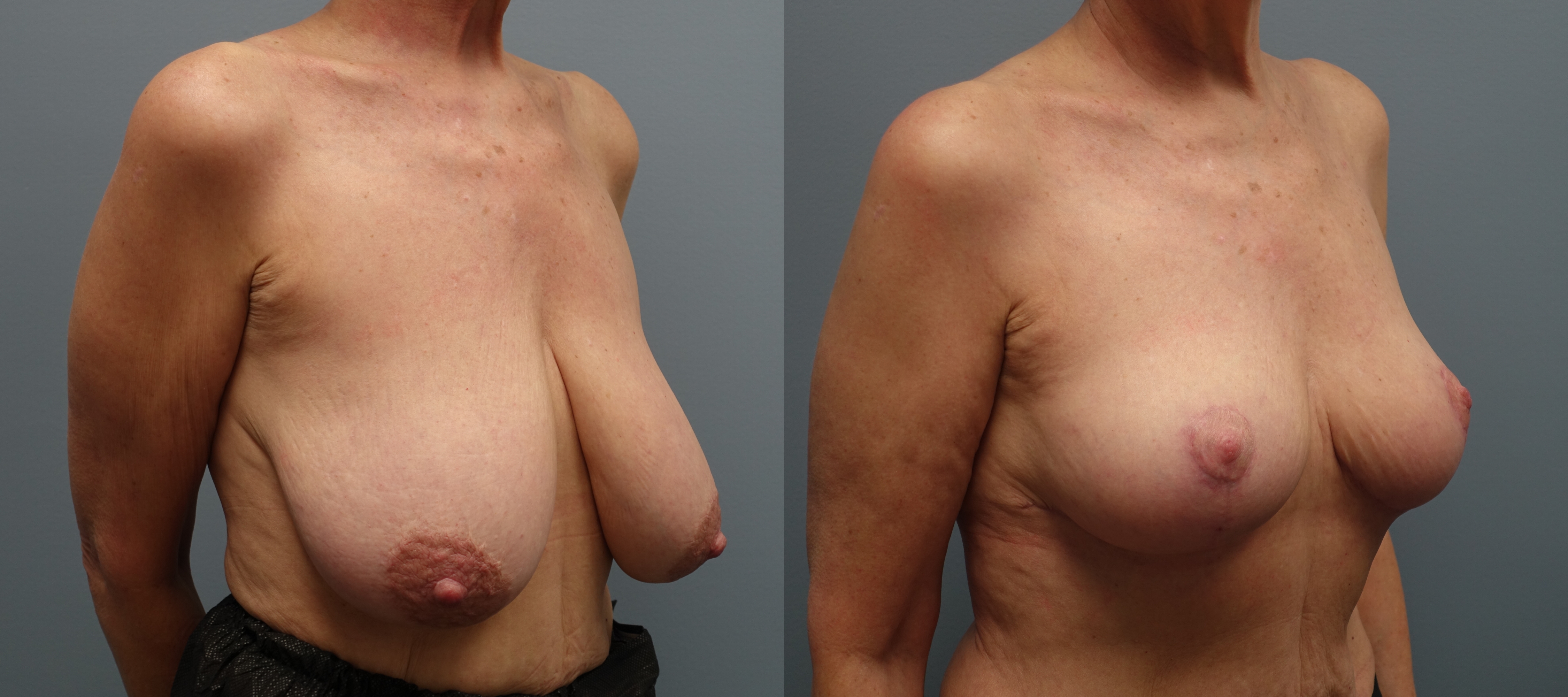 Breast Reduction. 
