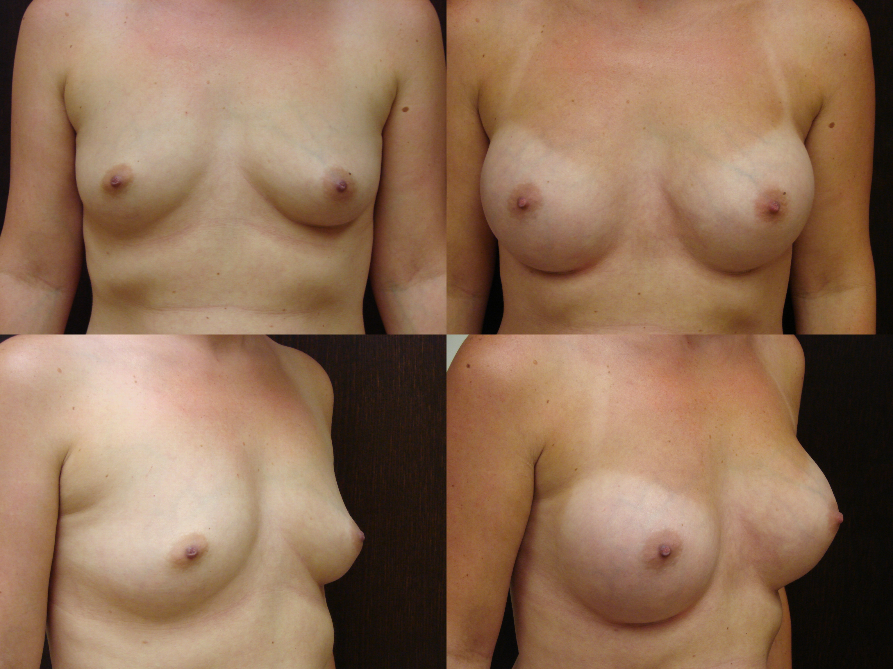 Breast Implants Savannah Breast Enhancement