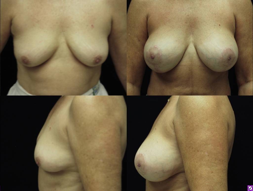 breast enhancement savannah breast lift