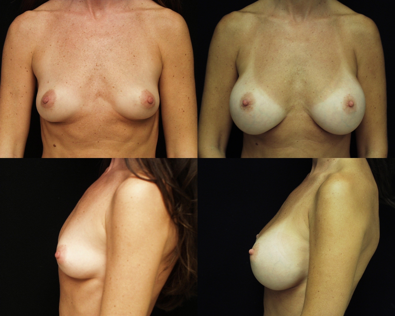 Breast Augmentation by Dr. E. Ronald Finger