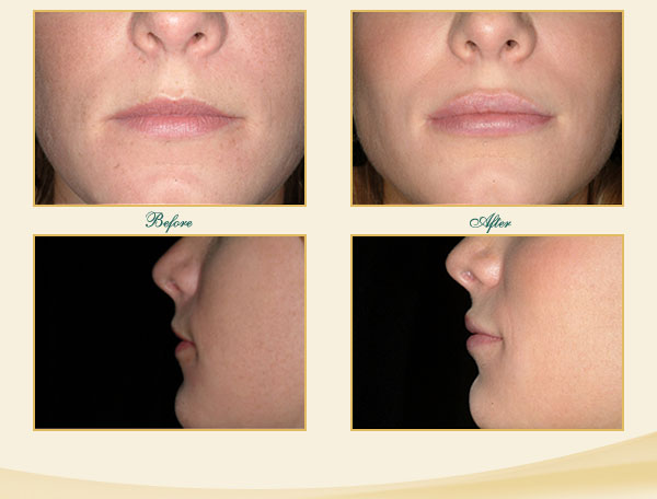 Juvederm Savannah Lip Enhancement