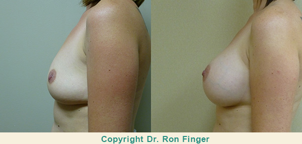Breast Lift Gallery E. Ronald Finger