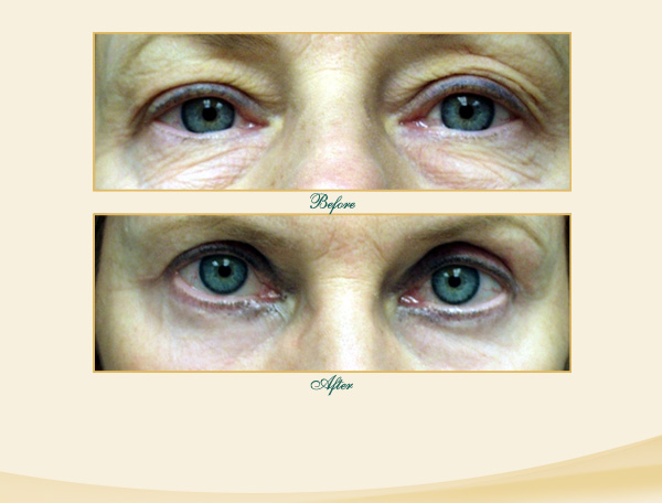 Brow & Eyelid Lift