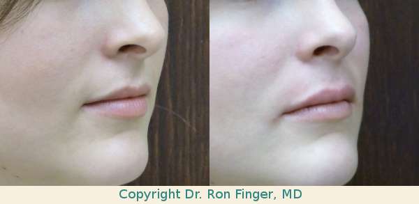 Juvederm Lip Injections Savannah