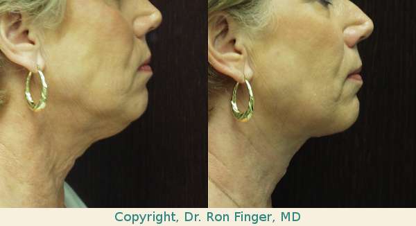 Liposuction and anterior resection of neck skin savannah