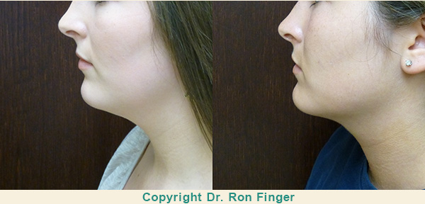 Savannah neck reduction