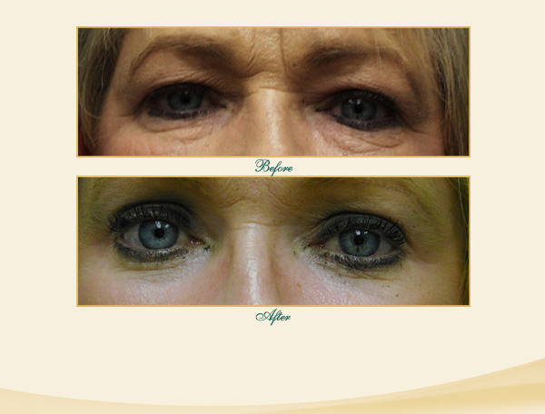 Brow & Eyelid Lift