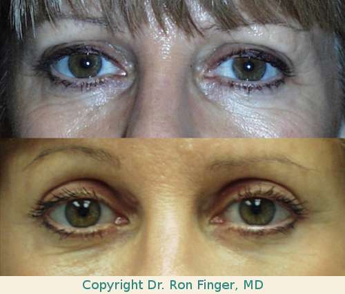 Upper and lower lid blepharoplasty