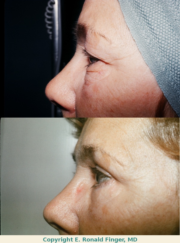 Before and one year after upper and lower eyelid lift (blepharoplasty)