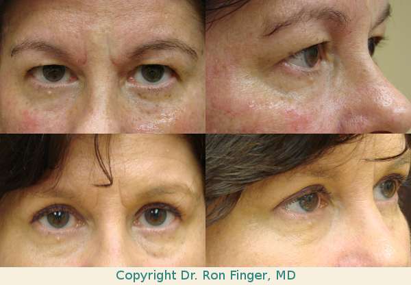 Upper lid blepharoplasty