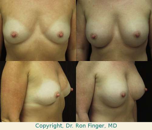 Breast Lift Gallery E. Ronald Finger