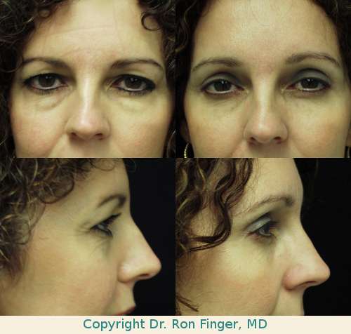 Upper and lower lid blepharoplasty