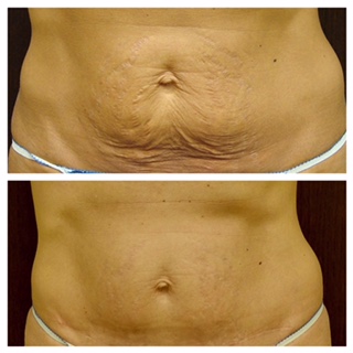 Before and After Mini- Tummy Tuck Procedure