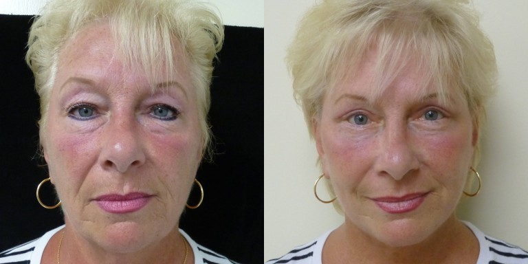 Facelift and eyelid surgery can go hand in hand 