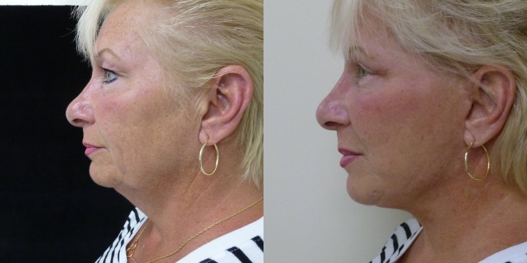 Before and After modified facelift , upper and lower eyelid lift, fat transfer to the face, and eyelids.