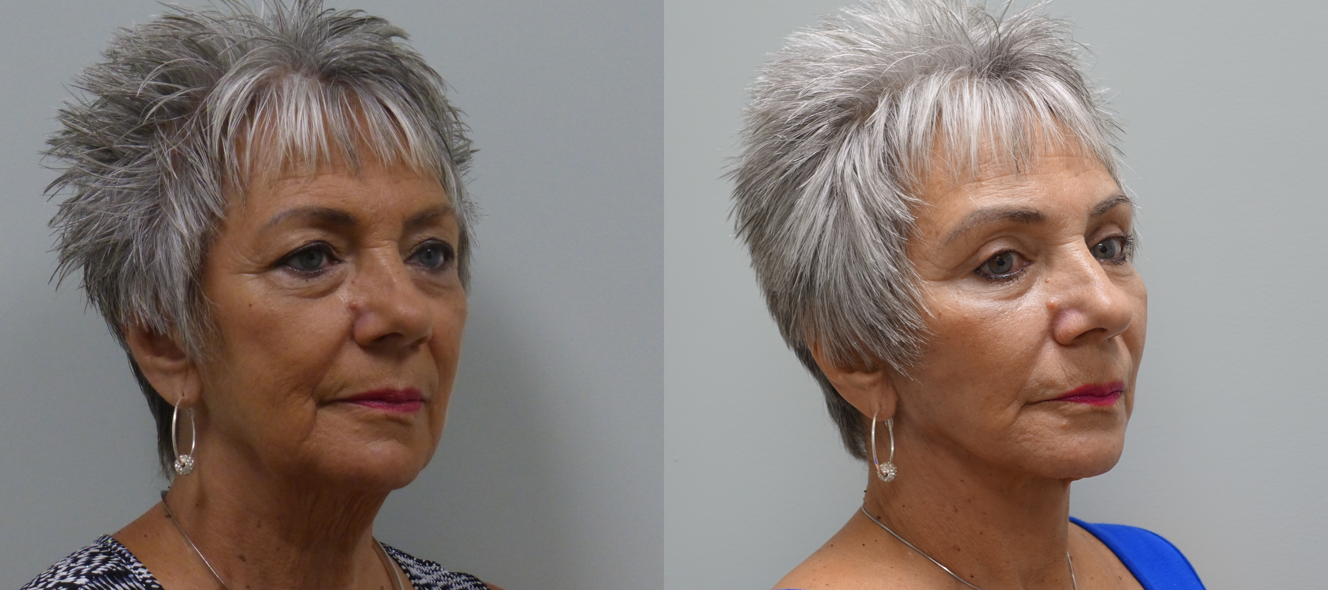 Before and after modified facelift with upper and lower lid blepharoplasty, and fat transfer to the face.