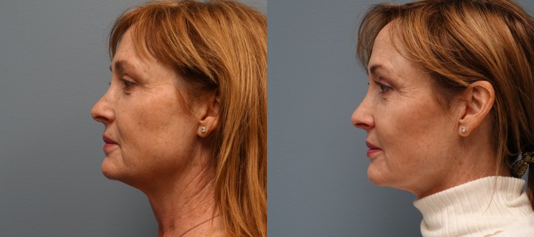 Sculptra