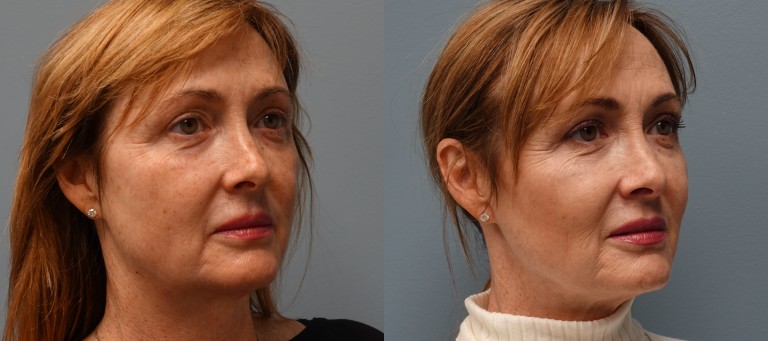 Sculptra