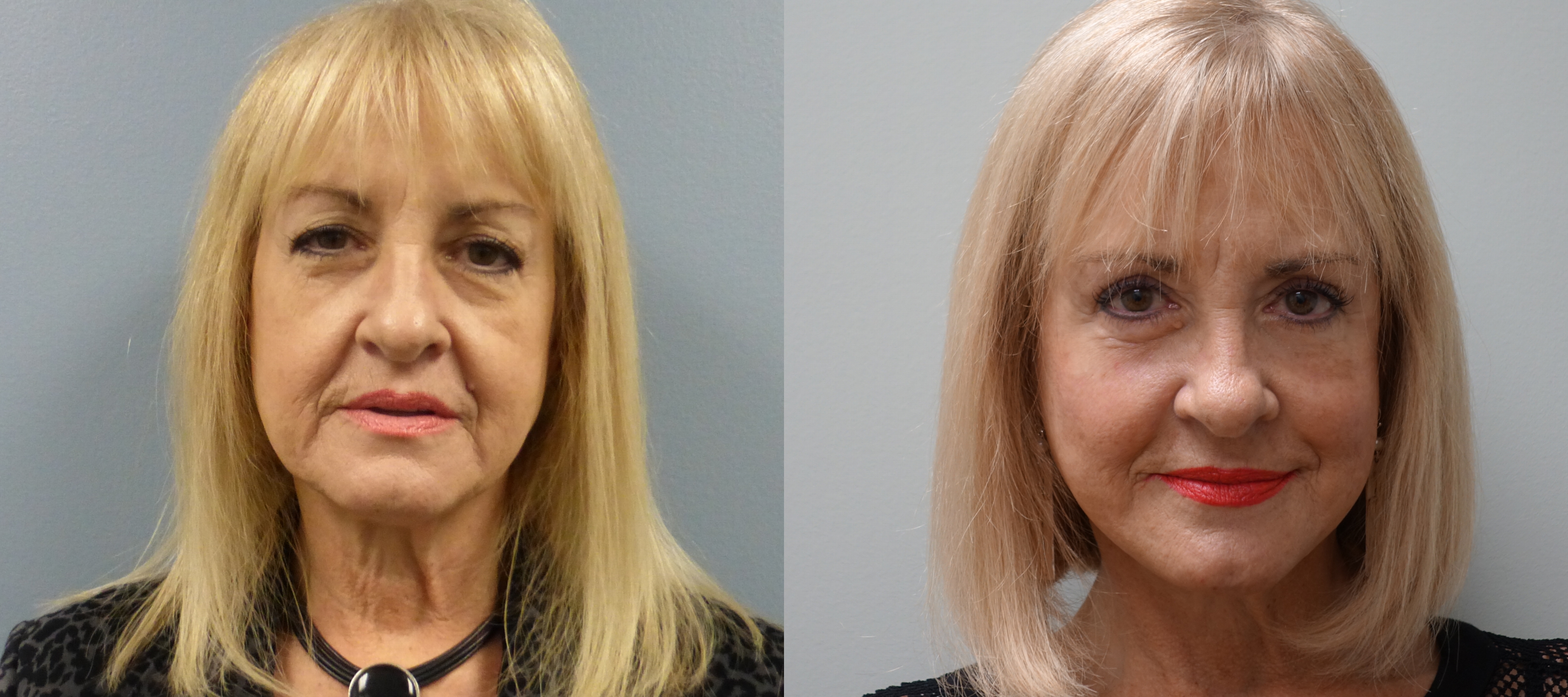 Before and after Facelift, eyelid lift and silicone implants on the bone under the lower lids.