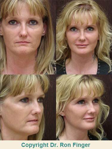 Before & After Full -Facelift Fat Grafts & Co2 Laser. 