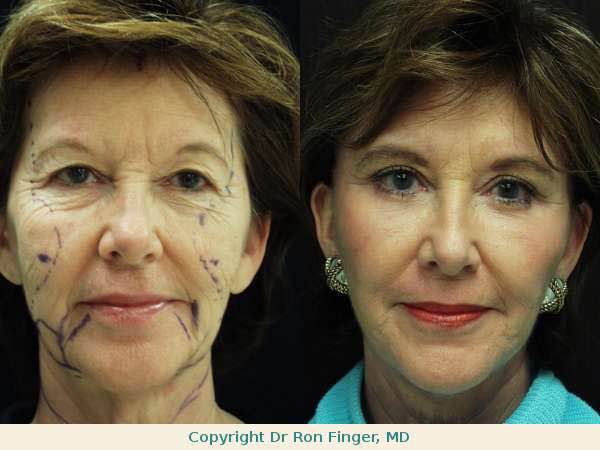 Before and after Facelift, Brow-Lift, Upper & Lower Blepharoplasty, Fat Grafts & Liposuction of the Chin.