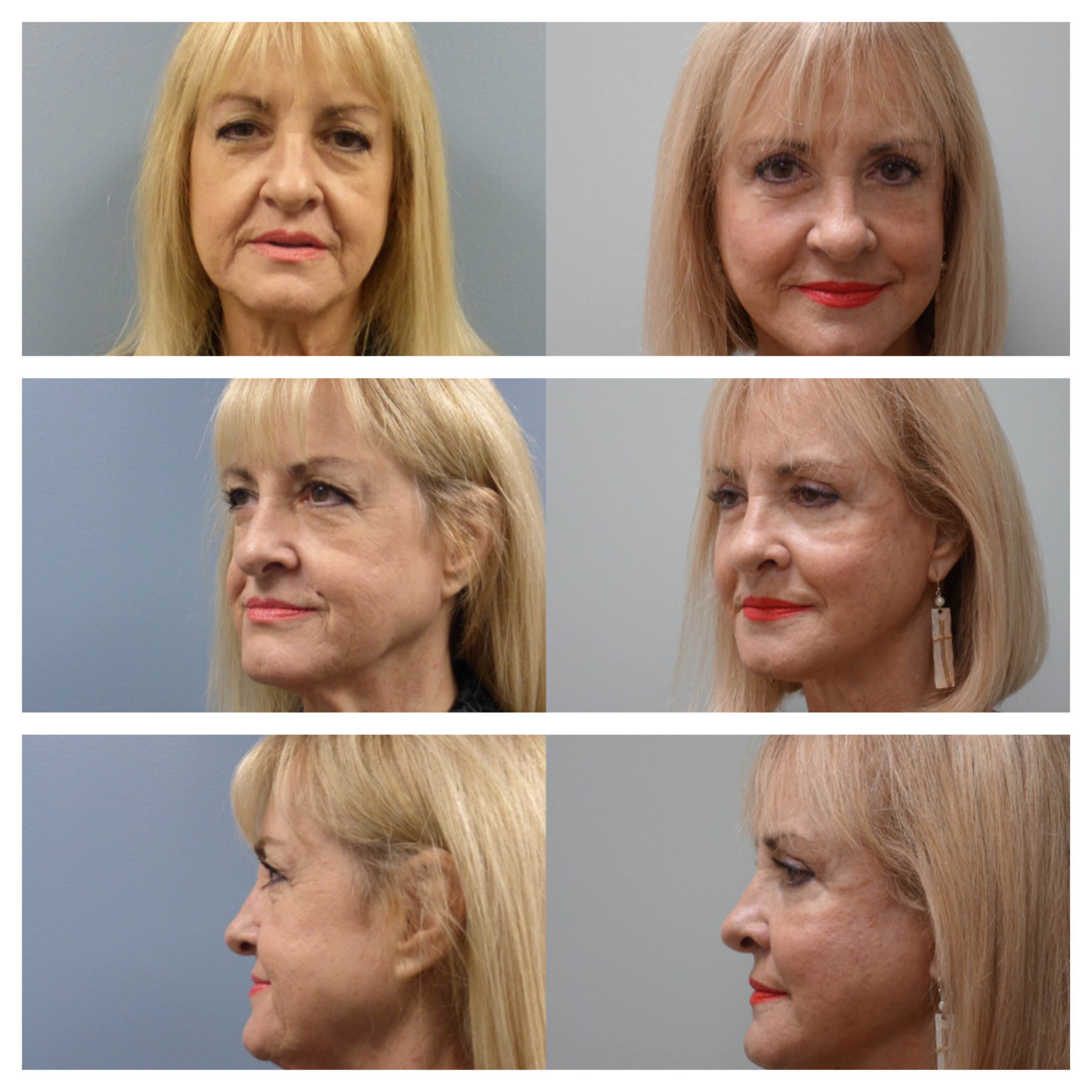 Before & After Full-Facelift, Silicone Implants on the Bone of Lower Eyelids & Upper Blepharoplasty