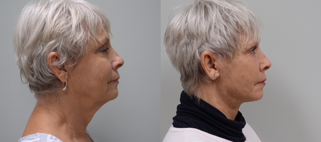 65 year old before and 6 weeks after a modified facelift, fat grafts to the face and CO2 laser of lower eyelids and around the mouth.