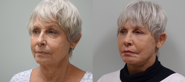 65 year old before and 6 weeks after a modified facelift, fat grafts to the face and CO2 laser of lower eyelids and around the mouth.