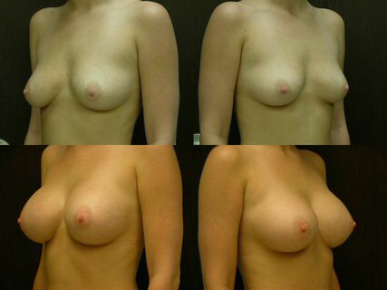breast implants savannah breast augmentation