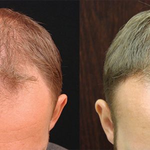 NeoGraft Cost for Neograft