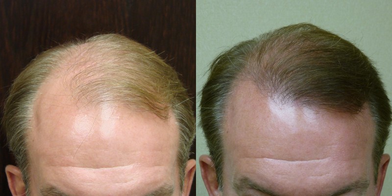Savannah Male Hair Transplant NeoGraft