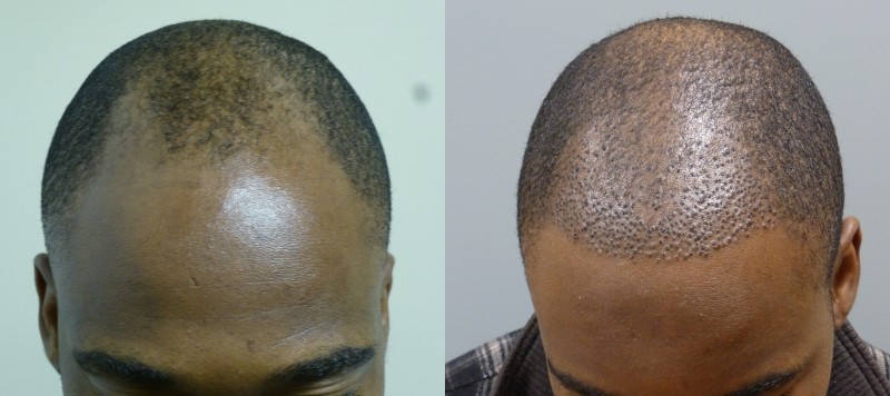 African American Hair Restoration