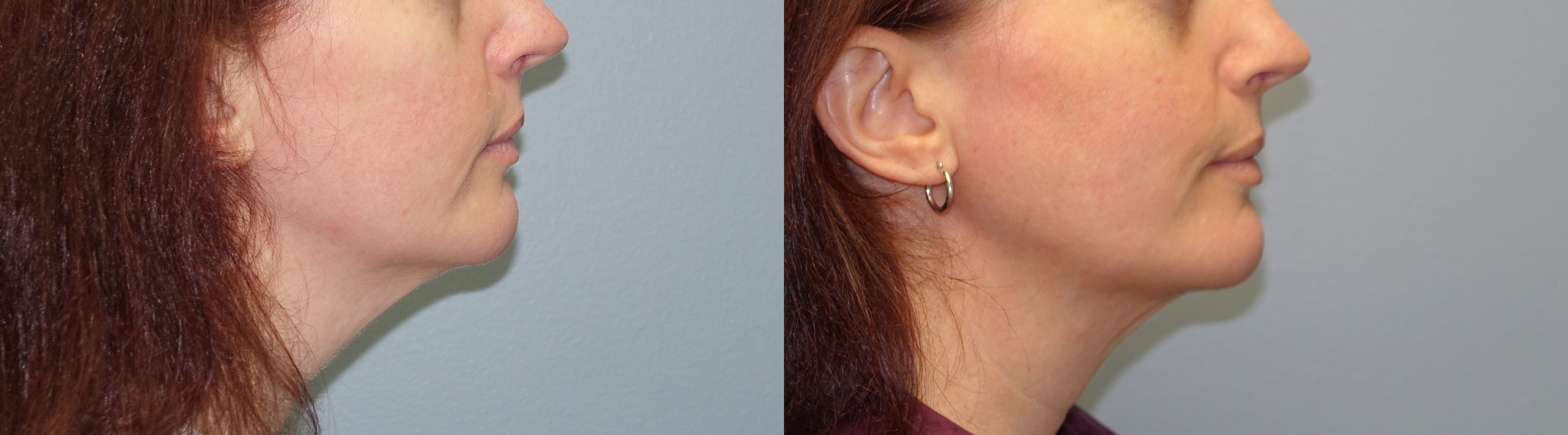 ThermiTight and Lipo of Neck – 44 year old – Before and 1 month after side view Thermitight and lipo of neck