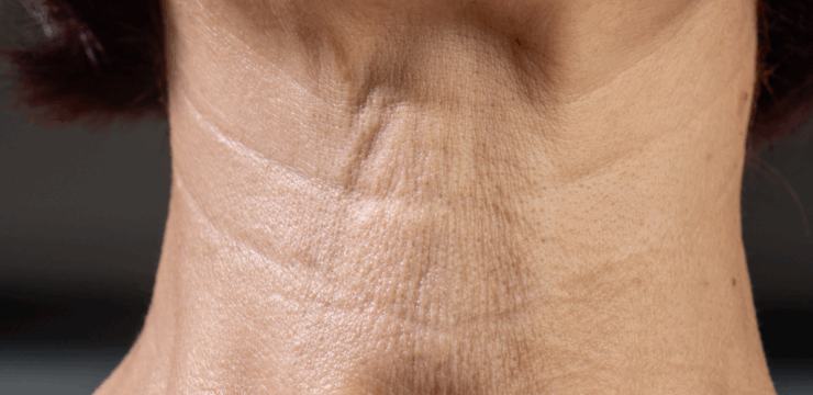 Neck Wrinkles treatment at Finger and Associates