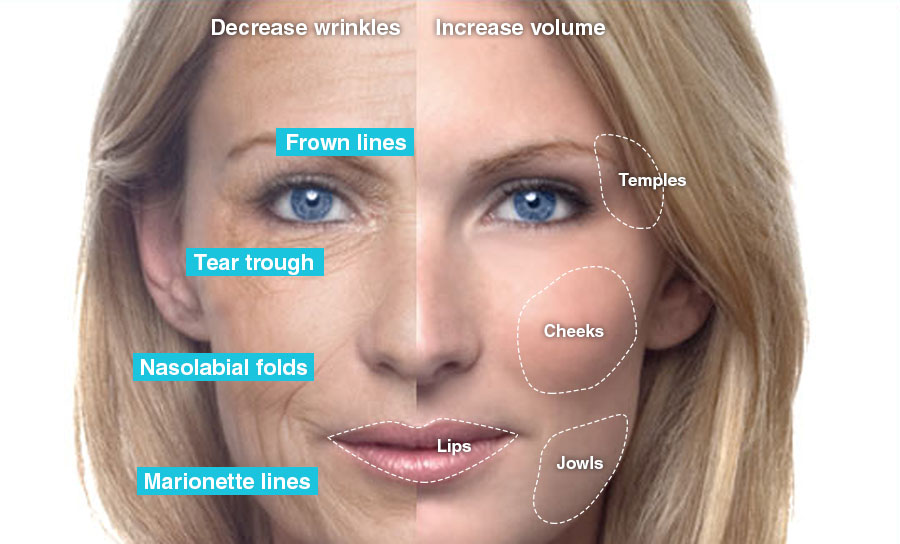 Non-Surgical Facelifts