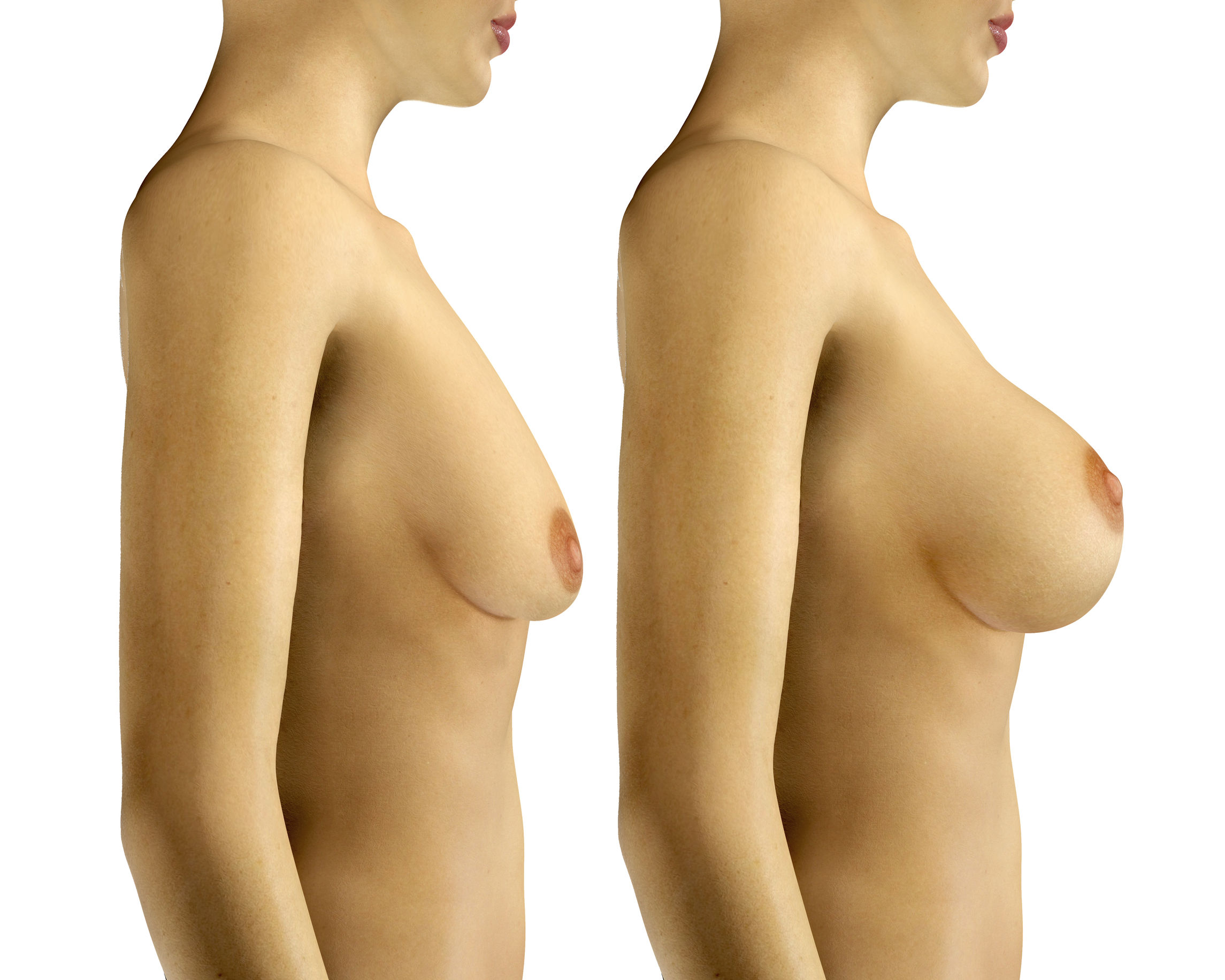 Rapid Recovery Breast Augmentation