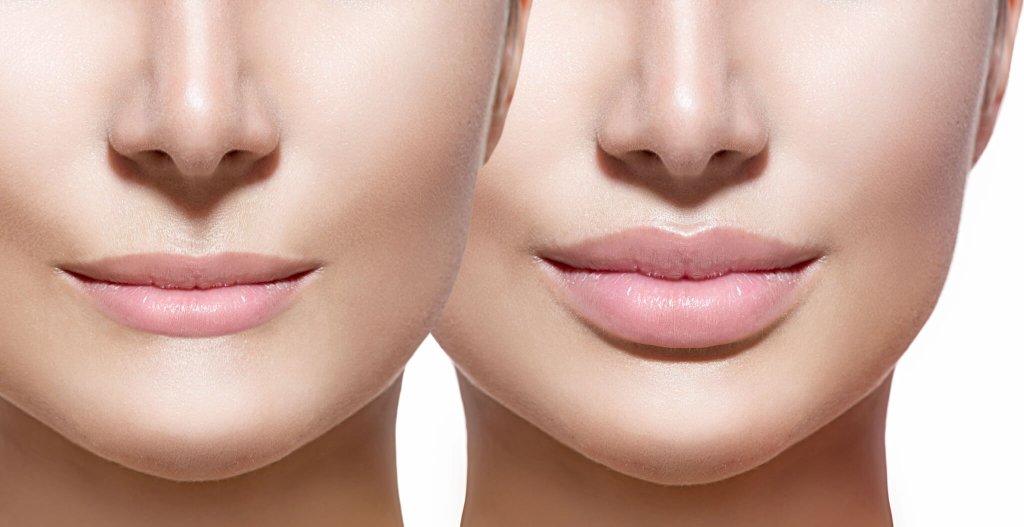 Fuller Lips with the help of fillers can be beautiful and attractive.