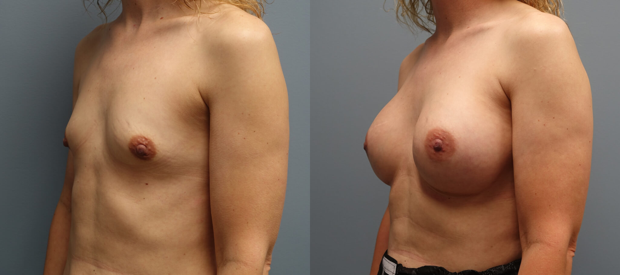 Breast Lift Gallery E. Ronald Finger