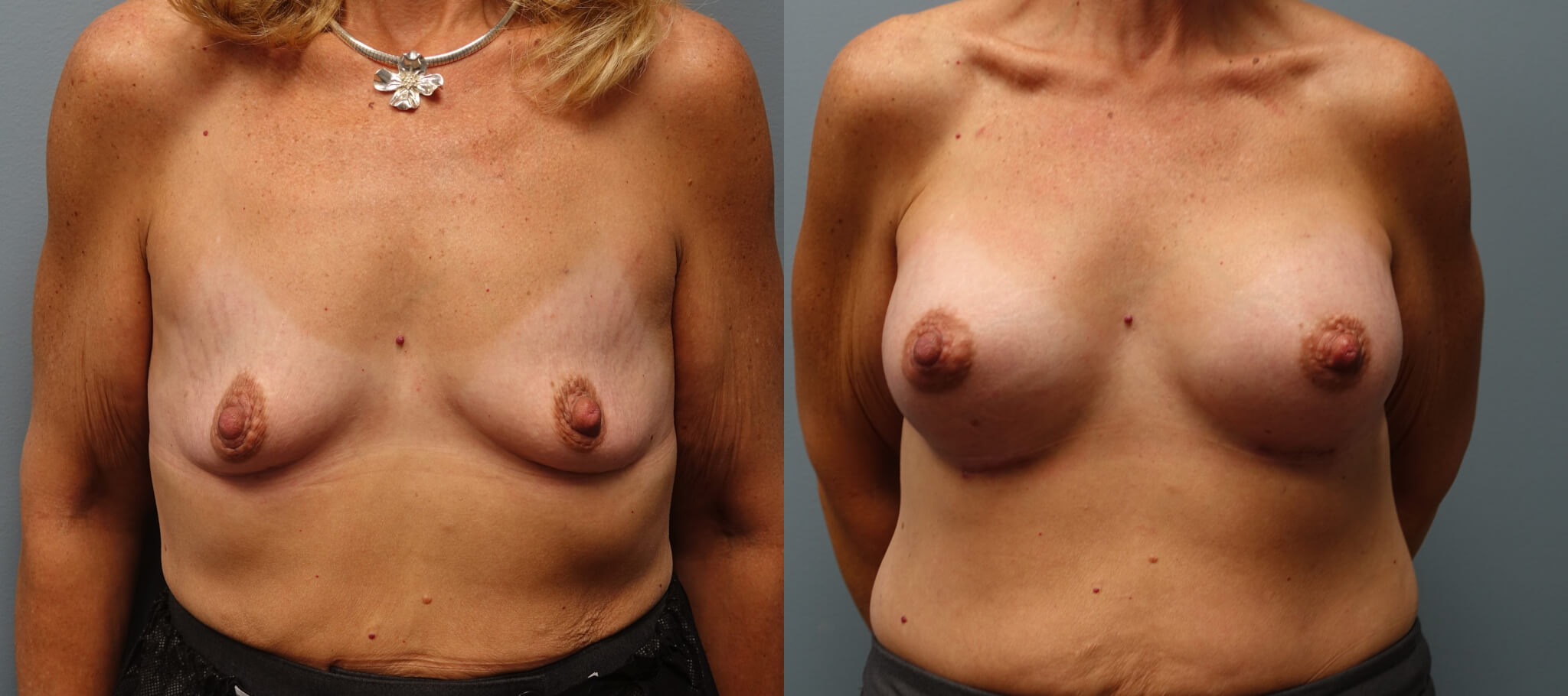 Breast Augmentation 48 year old 400High profile, gel, submuscular before and 1 month after