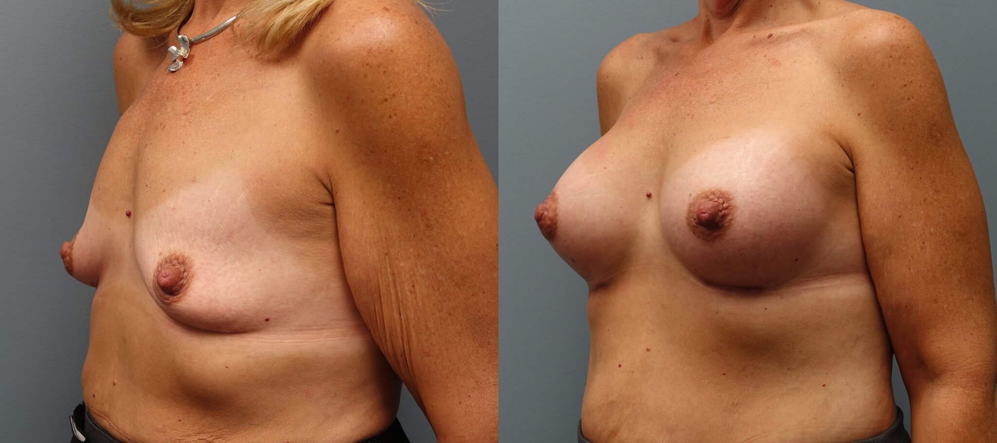 Breast Augmentation 48 year old 400High profile, gel, submuscular before and 1 month after